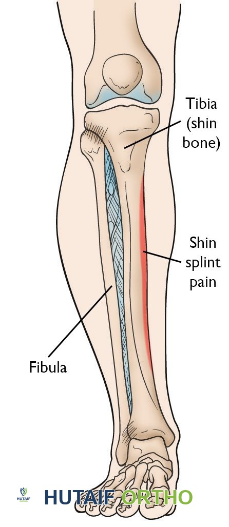Location of pain from shin splints